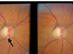 Detection of Progressive Glaucomatous Optic Neuropathy Using Automated Alternation Flicker With Ster Detection of Progressive Glaucomatous Optic Neuropathy Using Automated Alternation Flicker With Ster
