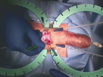 Development of a High Fidelity 3-piece Inflatable Penile Prosthetic model