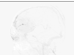 Developmental Venous Anomaly Inside a Glioblastoma Developmental Venous Anomaly Inside a Glioblastoma