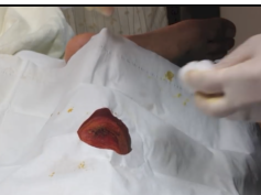 diabetic abscess