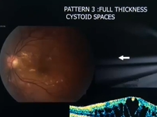 Diabetic Retinopathy
