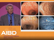 Diagnosing and treating Crohn's disease of the esophagus, stomach, and duodenum Diagnosing and treating Crohn's disease of the esophagus, stomach, and duodenum