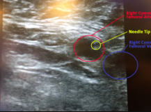 Diagnostic Angiogram Diagnostic Angiogram