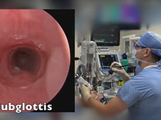 Diagnostic Microdirect Laryngoscopy and Bronchoscopy (MLB)