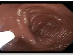Dialated Gastro-jejunal Anastomosis after Gastric Bypass - 2