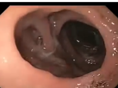 Dialated Gastro-jejunal Anastomosis after Gastric Bypass