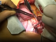 Diaphragm plication in adult patients with diaphragm paralysis Diaphragm plication in adult patients with diaphragm paralysis