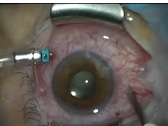 Diathermy to Seal Leaking Sclerotomies in Small-Gauge Vitrectomy Diathermy to Seal Leaking Sclerotomies in Small-Gauge Vitrectomy