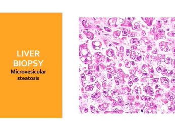 Difficult diagnosis : Case presentation - ISPGHAN 2020 Conference