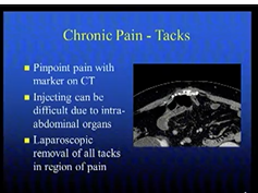 Difficult Problems In Reasonable Patients Panel: Abdominal Wall Pain, Following Ventral Hernia Difficult Problems In Reasonable Patients Panel: Abdominal Wall Pain, Following Ventral Hernia