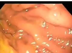 Difficult to Identify Gastro-gastric Fistula