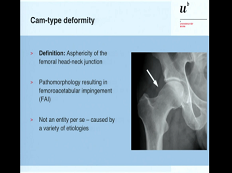 Difformités de Cam et algorithmes de traitement