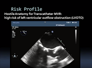 Direct surgical transcatheter heart valve implantation in a calcified mitral valve Direct surgical transcatheter heart valve implantation in a calcified mitral valve