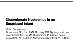 Disconjugate Nystagmus in an Emaciated Infant Disconjugate Nystagmus in an Emaciated Infant