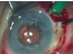 Dislocated Lenses After Cataract Surgery - Removal and Re-Placement Dislocated Lenses After Cataract Surgery - Removal and Re-Placement