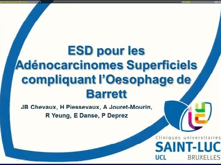 Dissection endoscopique sous-muqueuse pour les adénocarcinomes superficiels compliquant l’œsophage de Barrett : résultats d’un centre tertiaire européen
