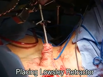 Dissection of Neovaginal Space in Gender-affirming Vaginoplasty