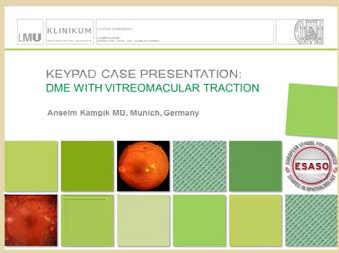 DME with vitreomacular traction DME with vitreomacular traction