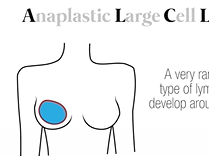 Do Textured Implants Cause ALCL Cases