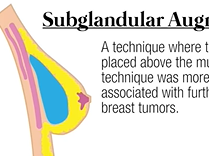 Does Breast Augmentation Affect Breast Cancer Detection?: Plastic Surgery Hot Topics Does Breast Augmentation Affect Breast Cancer Detection?: Plastic Surgery Hot Topics