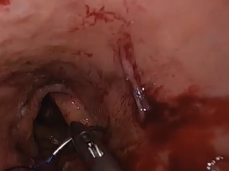 Dont be Stumped by the Stent! TaTME in the Removal of a Stented Rectal Cancer Dont be Stumped by the Stent! TaTME in the Removal of a Stented Rectal Cancer