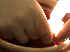 Double-barrelled Wet Colostomy.