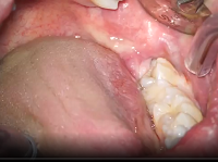 Double Elevator Wisdom Tooth Extraction Without Forceps