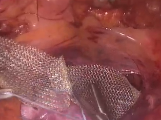 Double POPS (Pelvic Organ Prolapse Suspension)