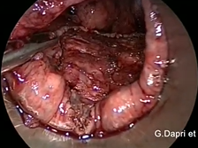 Double Transanal Endolaparoscopic Large Anal Canal and Low Rectum Polyps Resection Double Transanal Endolaparoscopic Large Anal Canal and Low Rectum Polyps Resection
