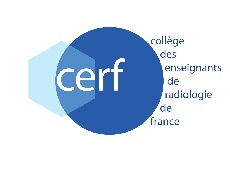 Douleur fébrile de la FIG : diverticulite et diagnostic différentiel