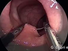 Down-To-Up Transanal Rectal Resection With TME Assisted By Single-Incision Laparoscopy Down-To-Up Transanal Rectal Resection With TME Assisted By Single-Incision Laparoscopy