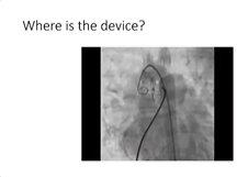 Dr Ramakrishnan S AIMS Spotters Angios ECGS Discussion 28th June 2020