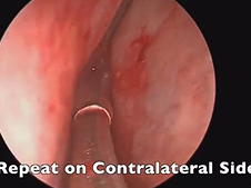Draf III (Endoscopic Modified Lothrop) Procedure