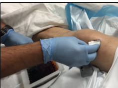 drainage of fluid from a knee bursa