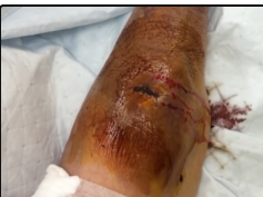 drainage of infected hematoma