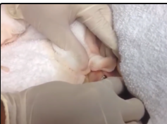 Drake's Drain & Staple Removal! Best of Dr. ER