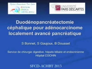 Duodénopancréatectomie céphalique pour adénocarcinome localement avancé pancréatique Duodénopancréatectomie céphalique pour adénocarcinome localement avancé pancréatique
