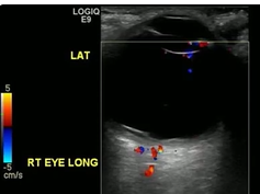 Dynamic Color Doppler Imaging of Morning Glory Disc Anomaly Dynamic Color Doppler Imaging of Morning Glory Disc Anomaly