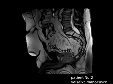 Dynamic MRI to Assess Pelvic Floor Reconstruction with Strattice Mesh after eLAPE for Rectal Cancer Dynamic MRI to Assess Pelvic Floor Reconstruction with Strattice Mesh after eLAPE for Rectal Cancer