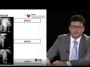 EACVI free webinar: Contrast enhanced stress echo to assess the need for coronary intervention EACVI free webinar: Contrast enhanced stress echo to assess the need for coronary intervention