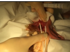 EARLOBE ABSCESS: CYST INFECTION