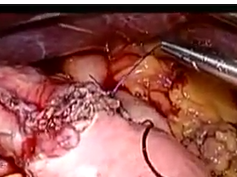 Early Experience With A V-Lock Absorbable Suture In Roux-En-Y Gastric Bypass