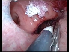 Early transanal closure after vacuum-assisted drainage for anastomotic leakage in rectal cancer Early transanal closure after vacuum-assisted drainage for anastomotic leakage in rectal cancer