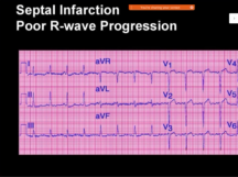 ECG Diagnosis of ST Elevation Myocardial Infarction (STEMI)