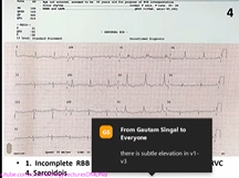 ECG Discussion Dr C NARASIMHAN 16th Cardiology Update 2020