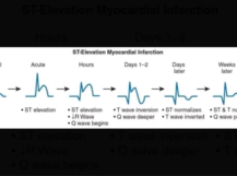 ECG interpretation made easy