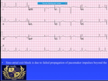 ECG Quiz with explanation and answers 2