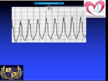 ECG Quiz with explanation and answers part 1