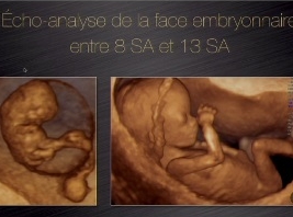 Echo-analyse de la face embryonnaire entre 8 SA et 13 SA Echo-analyse de la face embryonnaire entre 8 SA et 13 SA