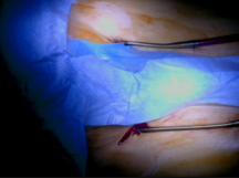 ECMO Related Limb Ischemia: T-Graft Technique ECMO Related Limb Ischemia: T-Graft Technique